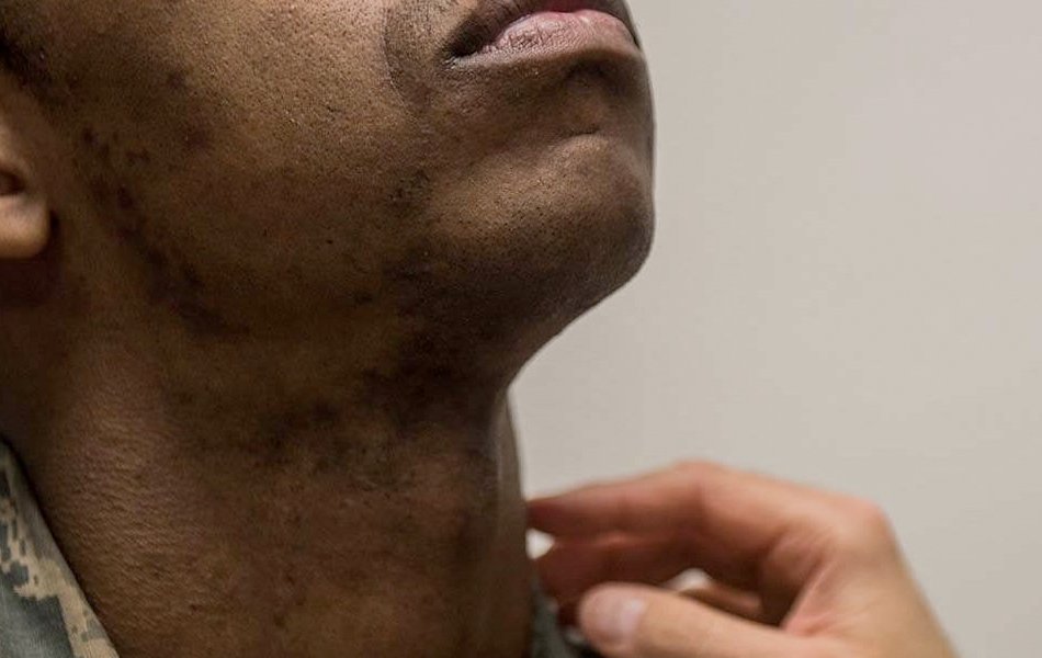 Could My Sore Throat Be Strep?