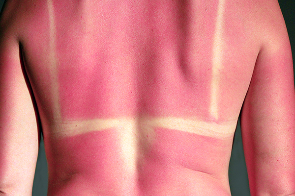 How Can I Stay Safe in the Sun this Summer?