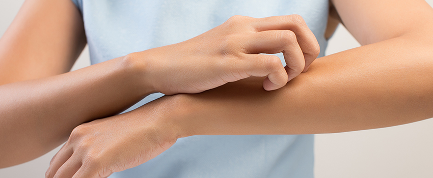 How Can I Prevent Bug Bites This Summer?