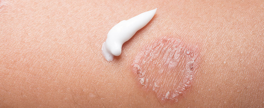 How Can I Get Rid of Ringworm?