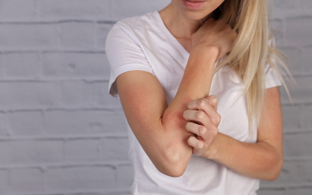 How Can I Tell the Difference Between Psoriasis and Eczema?