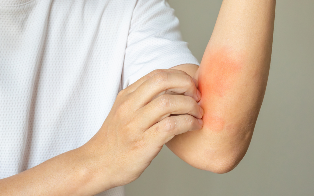 Could This Be Heat Rash? 