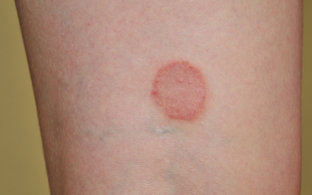 Tips for Preventing Ringworm
